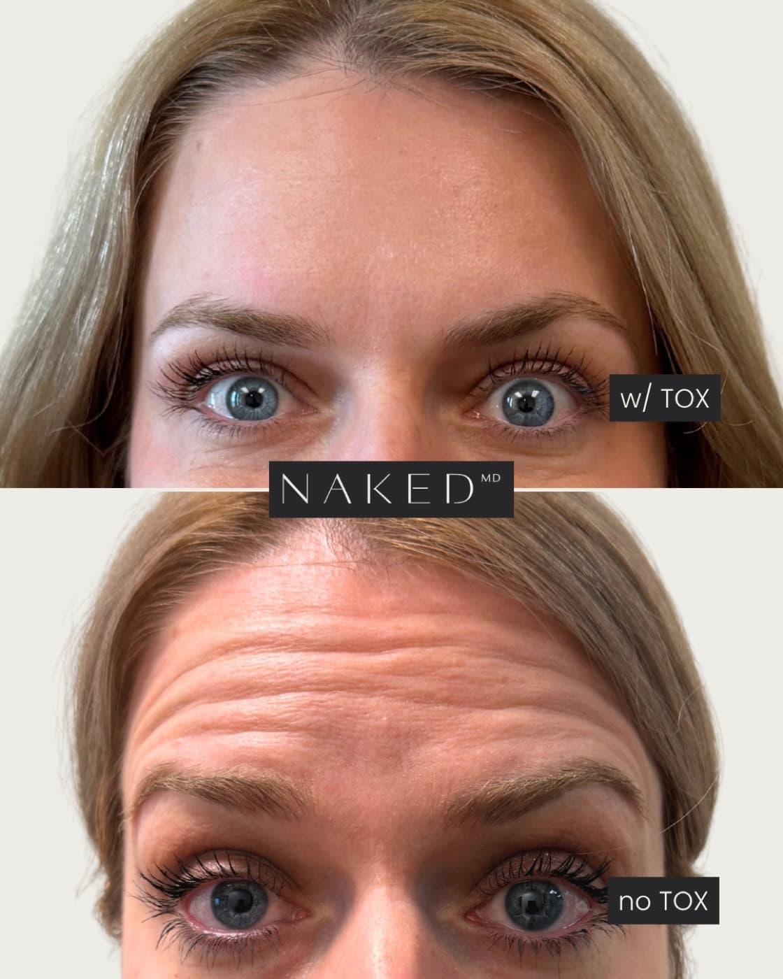 Forehead TOX before and after — softened forehead lines