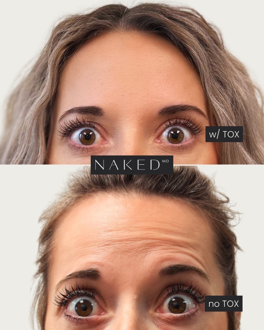 Forehead TOX before and after — smoother forehead