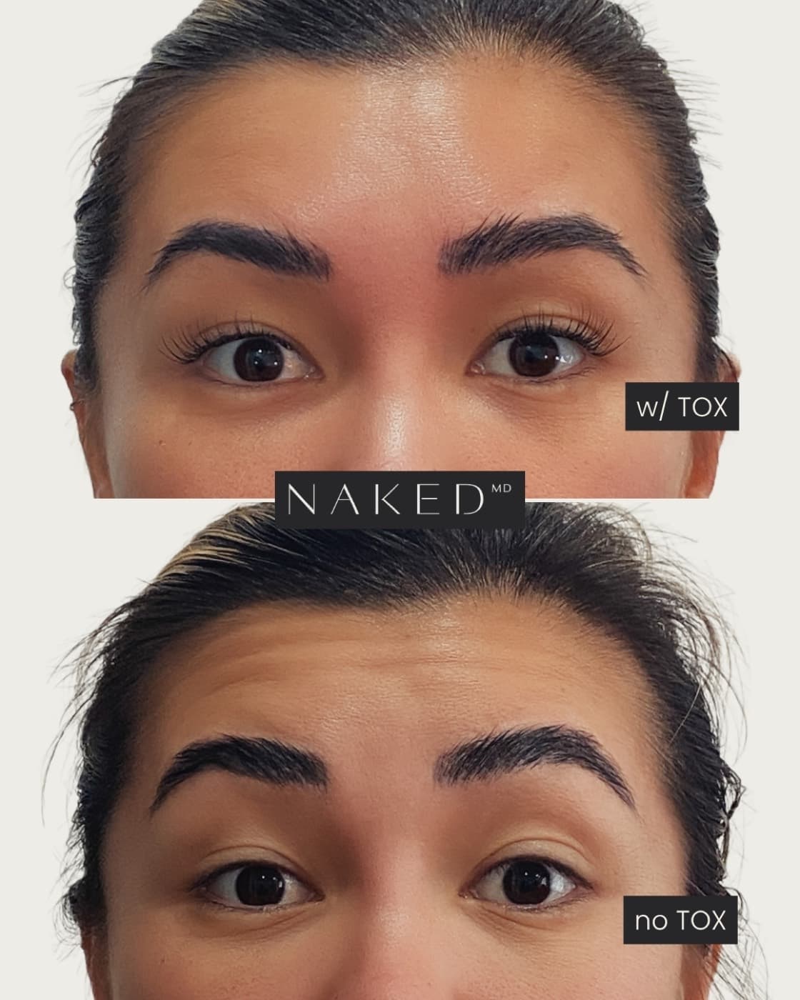 Forehead TOX before and after result